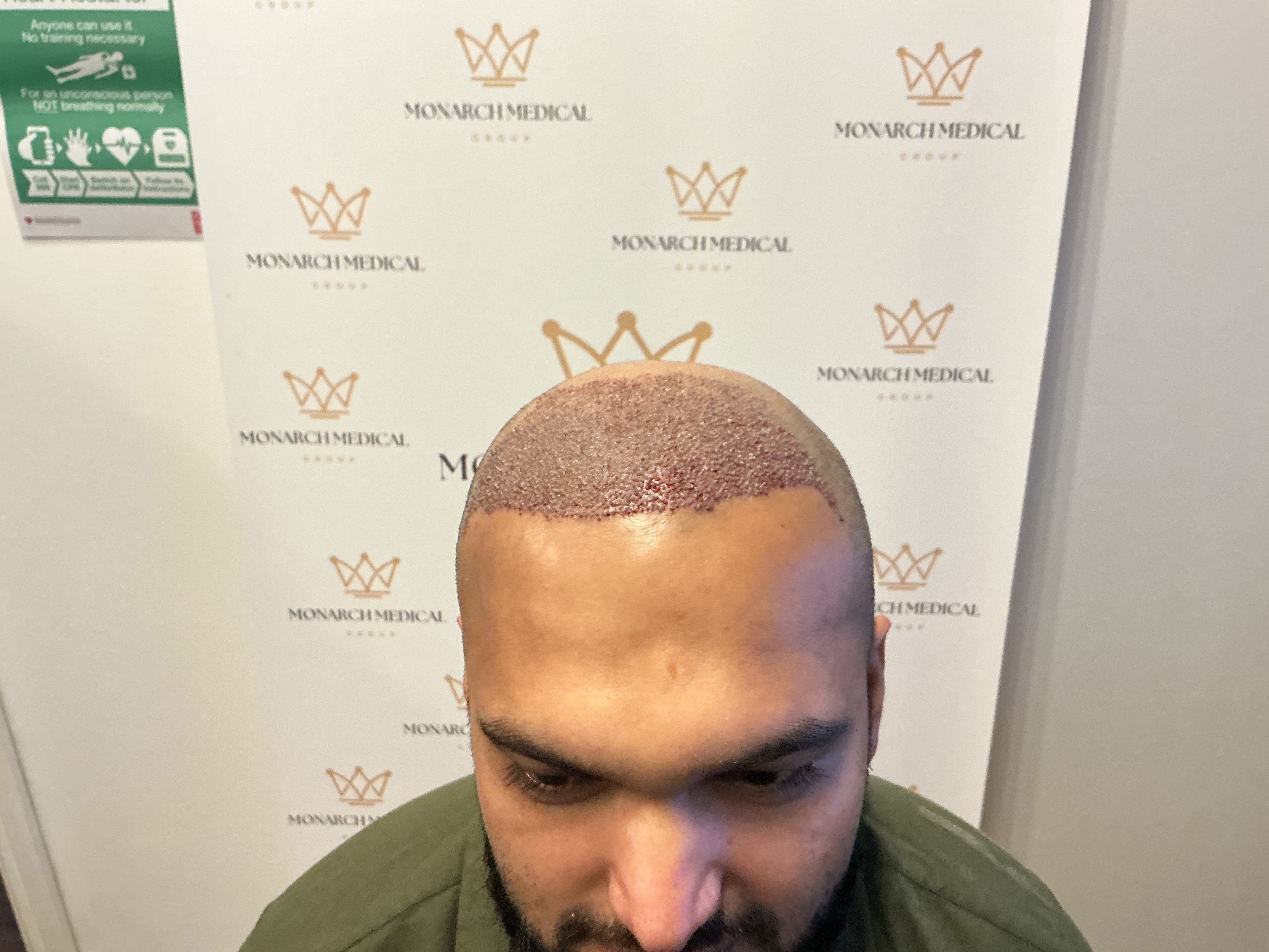 Norwood 7 hair transplant — Hussain result photo 4